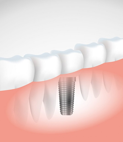 dental Implants | Ripley Dental