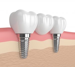 Root Canal